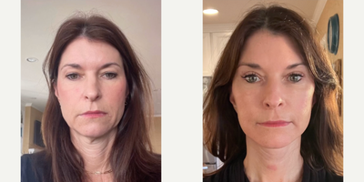 Woman treated with Facelift - Are u ready for it! 1 month post DEFINE LIFT Plus. She looks amazing from her brows to her neck everything in perfect order without looking pulled or any stigmata of a facelift! But not everything is as it seems, she had a tough time with the initial 2/3 weeks but now she is coming around. I am grateful she trusted me with her beautiful face and she will only improve from here!