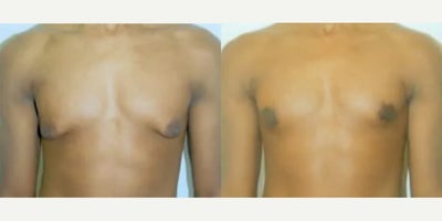 Man treated with Gynecomastia Surgery - Man treated with Gynecomastia Surgery