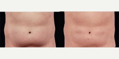 Man treated with CoolSculpting - Man treated with CoolSculpting. Patient is shown before and 90 days after one treatment.