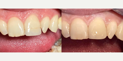25-34 year old man treated with Tooth Repair - We repaired the crack in our patient's tooth with a porcelain filling.