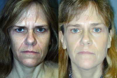 This 52-year-old Woman had a Face Lift, an Endoscopic Brow Lift, and a Lower Blepharoplasty - This 52-year-old Woman had a Face Lift, an Endoscopic Brow Lift, and a Lower Blepharoplasty.