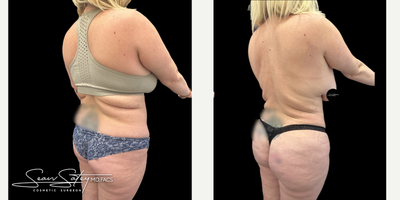 35-44 year old woman who is 3 months post-op from VASER assisted liposuction - 38 year old amazing patient that underwent VASER assisted liposculpting of the abdomen, flanks, upper/middle/lower back and a BBL procedure (fat transfer to the buttocks and lateral hips). Results shown are 3 months post-op.
