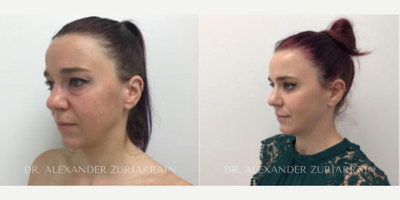 35-44 year old woman treated with Eyelid Surgery - 35-44 year old woman treated with Eyelid Surgery- 3 months post-op