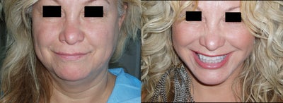 Mini Lift under local anesthesia - 
	Face and Neck Mini Lift done under local anesthesia only

