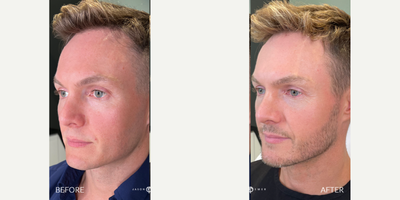 25-34 year old man treated with Lightsheer Laser - Our patient is a TV host on AGT, and wants to look his best on camera. He has been coming to us for nearly 8 years because he always gets the best results. His main concerns are redness and brown spots on his skin. To maximize results, our patient followed his Advalight treatment with the Emer Skin Illuminating Mask. This is how his skin reached that angelic level. He also used some other products from Emer Skin to further enhance his results. He is absolutely loving his results and all of Dr. Emer's after care products that helped him glow on the red carpet!