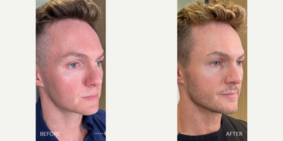 25-34 year old man treated with Lightsheer Laser - Our patient is a TV host on AGT, and wants to look his best on camera. He has been coming to us for nearly 8 years because he always gets the best results. His main concerns are redness and brown spots on his skin. To maximize results, our patient followed his Advalight treatment with the Emer Skin Illuminating Mask. This is how his skin reached that angelic level. He also used some other products from Emer Skin to further enhance his results. He is absolutely loving his results and all of Dr. Emer's after care products that helped him glow on the red carpet!