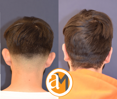 18-24 year old man treated with Earfold - Our patient has an otoplasty or ear pinning procedure to correct the position of his ears. The procedure was completed in office by a specialized technique to minimize scaring.