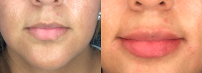 Vollure for this 24 Year Old Woman - This 24-year old female had 1 syringe of Vollure injected with a cannula. The results are immediate with no downtime.
