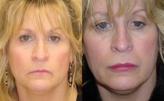Woman treated with Lip Fillers - Woman treated with Lip Fillers