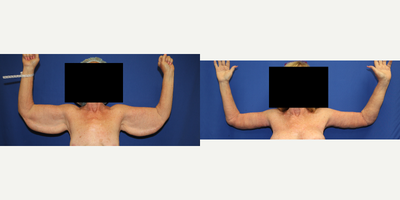 Arm Lift (front view) - This is a 61 year old female who had gastric bypass surgery and lost a significant amount of weight. She was unhappy with the excess sagging skin on her arms. She underwent an arm lift.