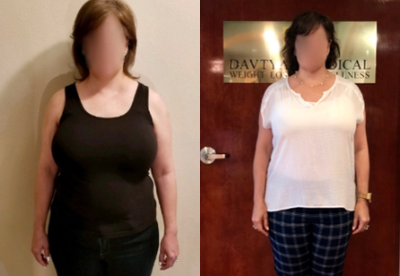 35-44 year old woman treated with Obalon Intragastric Balloon - Weight loss 1 month after placement of Obalon balloons.