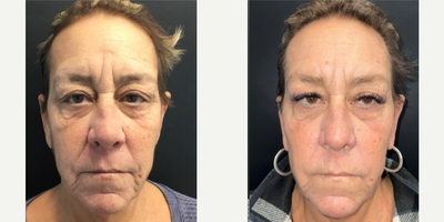 65-74 year old woman treated with NeoGen Plasma - 90 Days following one Neogen Plasma session on Full Face and Neck. Results continue to enhance for 12-24 months.