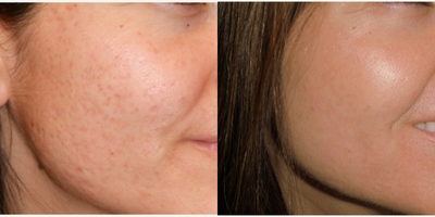 35-44 year old woman treated with Fractional CO2 Laser for Severe Acne Scars - Patient desired improvement of atrophic acne scars. Treated by Dr. Mahlberg with Syneron CO2RE Fractional CO2 laser.