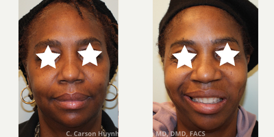 35-44 year old woman treated with Dimple Surgery - Cheek dimple surgery / dimpleplasty