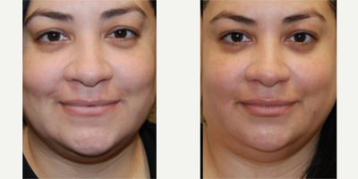 45-54 year old woman treated with Silikon 1000 to her lips. One treatment. - These photos were taken six weeks following a single lip augmentation treatment with Silikon-1000, an off-label filler for permanent results. You can see natural looking subtle enhancement, with reduction in the gap in our lovely patient's upper lip. Thank you.