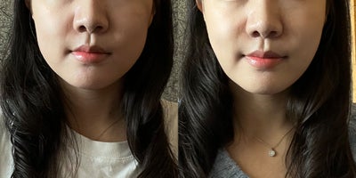 25-34 year old woman treated with Lipodissolve - Fat-dissolving injections to contour the facial line