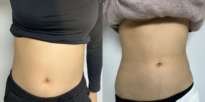 18-24 year old woman treated with Lipodissolve - Fat-dissolving injections to contour the abdominal area