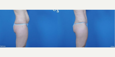 Woman treated with Tummy Tuck - Woman treated with Tummy Tuck