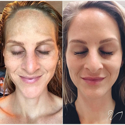 25-34 year old woman treated with VI Peel - VI peel results at The Skin Center Pittsburgh!