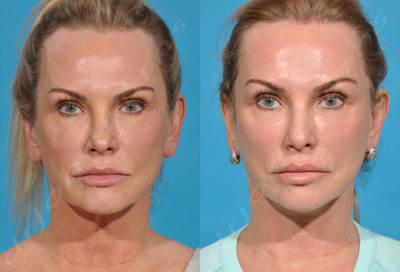 55-64 year old woman treated with Fractional Laser - Lift and Fill Facelift with skin resurfacing