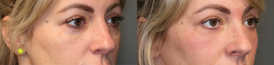 Lower Lid Filler and Laser - Lower lid filler and laser