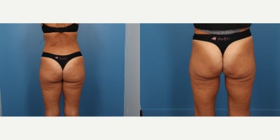 45-54 year old woman treated with Aveli - Aveli is a minimally invasive, FDA-cleared treatment for cellulite that targets the fibrous bands (septa) beneath the skin that cause dimpling. It works by precisely releasing these bands, allowing the skin to smooth out naturally. Aveli is known for providing long-lasting results with minimal downtime, and it offers a significant reduction in cellulite appearance after just one treatment.