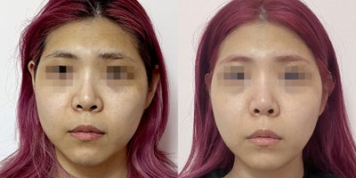25-34 year old woman treated with Lipodissolve - Fat-dissolving injections to contour the facial line