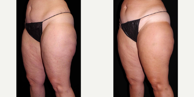 45-54 year old woman treated with Cellulaze - 45 year old female received Cellulaze to the outer thighs; photos depict the patient's results 11 weeks post-op.