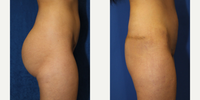 25-34 year old woman treated with Silicone Injection Removal - Meet our patient, a 30-year-old female standing at 5'4 and weighing 122 pounds. In 2017, she underwent two rounds of silicone injections in her buttocks in Las Vegas, NV, which resulted in pain and discomfort.In search of a solution, she consulted with the exceptional Dr. J. Timothy Katzen in Beverly Hills, CA, who suggested silicone removal, posterior bodylift, and bilateral lymph node removal. The three-hour-long surgery was successful in removing 2.76 pounds of silicone, skin and fat, and improving the overall health and appearance of her buttocks.We are delighted to hear that the patient is feeling good after her surgery. It's inspiring to see how cosmetic procedures can help individuals not just achieve their desired appearance but also improve their quality of life.We wish her continued health and happiness and applaud her for taking the necessary steps towards achieving her goals.