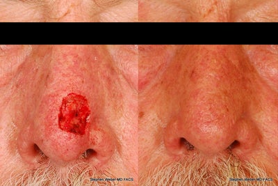 Mohs Surgery - Mohs Surgery