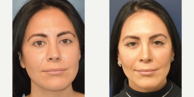 25-34 year old woman treated with Rhinoplasty, Septoplasty, Revision Rhinoplasty - A woman in her 30s, who had two previous rhinoplasties which left her with an over-projecting elongated nasal tip, drooping tip, hanging columella, tip asymmetry, and nostril asymmetry. She is now 8 months post-op from revision rhinoplasty with tip elevation, nasal tip deprojection to shorten the overall length of her nose, improvement of tip symmetry, dorsal hump reduction, improvement of nostril symmetry, correction of alar retraction, creation of a tip defining point, and placement of a columellar strut graft and spreader grafts using MTF cartilage to add tip support, tip refinement, and improve her breathing.
