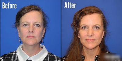 Woman treated with Facelift - Woman treated with Facelift