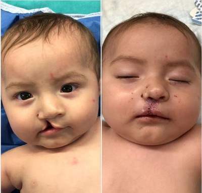 Woman treated with Cleft Lip And Palate Repair - Woman treated with Cleft Lip And Palate Repair