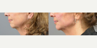 Woman treated with Dermal Fillers, Juvederm, Voluma - A Volume Lift is similar to a liquid facelift because only dermal fillers are used to achieve the desired result. Our goal with Volume Lift is to restore the youthful V shape and contour of the face by strategically, artfully and uniquely placing multiple syringes of filler using the same technique Dr. Marotta uses during a fat transfer procedure. The amount of filler needed to achieve the desired results is determined by your provider.Here is a patient who desired a more defined jawline but wasnt quite ready for surgical intervention. Our nurse injector was able to add visible contour and definition with multiple syringes of Juvederm Voluma to the cheeks, mandibular angle, pre-jowl sulcus and chin. After photo shown is immediately after injection.