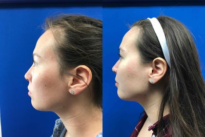 25-34 year old woman treated with Injectable Fillers - Restylane lyft injection to define cheek bone, jawline, and neck. Dr. Caughlin is getting known for his chin, neck, and jawline sculpting.