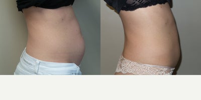 35-44 year old woman treated with Exilis Ultra - 32 year old female treated with Exilis Ultra to abdomen.