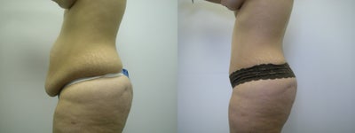 Woman treated with Tummy Tuck - Woman treated with Tummy Tuck to flatten and re-contour the abdomen and waist, by removing excess skin and fat, and tightening the underlying muscles.