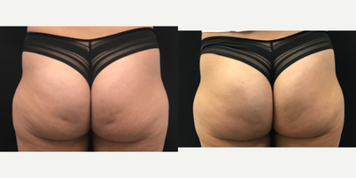 25-34 year old woman treated with Qwo - Results after 3 treatments of Qwo for mild to moderate cellulite on the buttocks