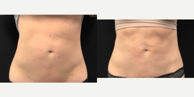35-44 year old woman treated with CoolTone - Results after receiving 6 treatments of CoolTone to the abdomen (treatments done 2-3 days apart over a 3 week period)