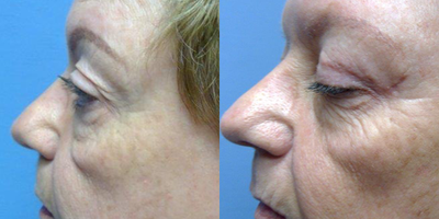 65-74 year old woman treated with Eyelid Surgery - Blepharoplasty removes excess skin from eyelids for a more alert, youthful appearance.