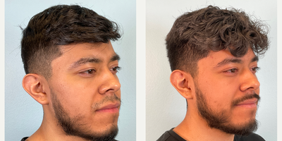 18-24 year old man treated with Ear Surgery - Cosmetic Ear Surgery