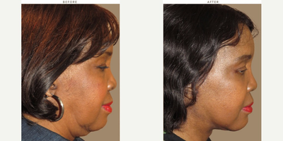 55-64 year old woman treated with Neck Lift - face and neck lift with chin augmentation