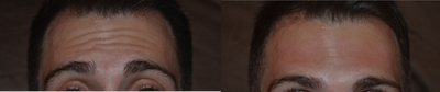 30 Year Old Male Treated For Forehead Lines - Botulinum toxin was used in small aliquots in the forehead for the treatment of active wrinkling.  Note no change in the eyebrow shape, no loss of expression, and no change in his masculine appearance.