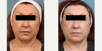 45-54 year old woman treated with BroadBand Light (BBL) - 45-54 year old woman treated with BroadBand Light (BBL)