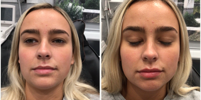 18-24 year old woman treated with Revanesse - 0.8 cc of Revanesse Versa injected into lips for balance/symmetry.
