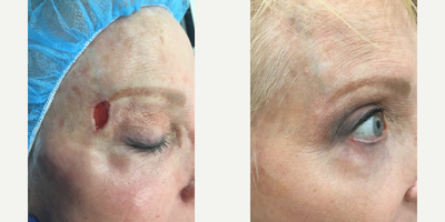 65-74 year old woman treated with Scar Removal - This is a lady who underwent a surgical removal of a skin cancer on the face in a very visible area around the eyebrow. The wound left behind was not closed by the surgeon because they felt that the patient would not benefit from a surgical scar repair. Dr. Karamanoukian in Santa Monica began a HIDEF scar protocol that includes primary surgical scar excision, multilayered skin repair with RF microneedling, laser therapy, scar modulation with Plato's Scar Serum, fractional laser, and PRP injections. In the short term, the patient used Plato's Scar serum to reduce inflammation and hypertrophy of scars.
