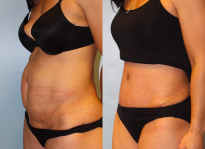 25-34 year old woman treated with Diastasis Recti Repair - Rectus diastasis repair performed with Tummy Tuck