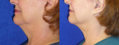 75 and up year old woman treated with CoolMini - Treatment with CoolMini