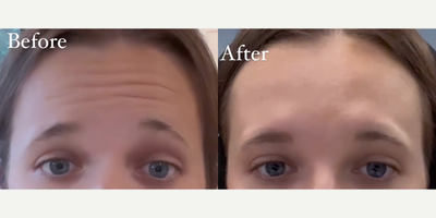 Woman treated with Dysport, Xeomin - Botox and Neuromodulator Insights