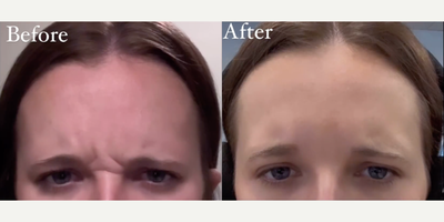 Woman treated with Dysport, Xeomin - Botox and Neuromodulator Insights